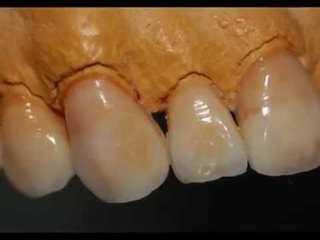 Diagnostic Wax-Up for Treatment Planning