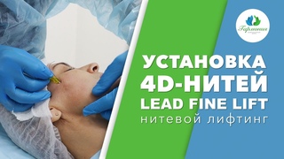 Нитевой лифтинг. Установка 4D-нитей LeadFineLift