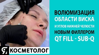 Волюмизация области виска и углов нижней челюсти новым филлером  QT Fill - Sub-Q